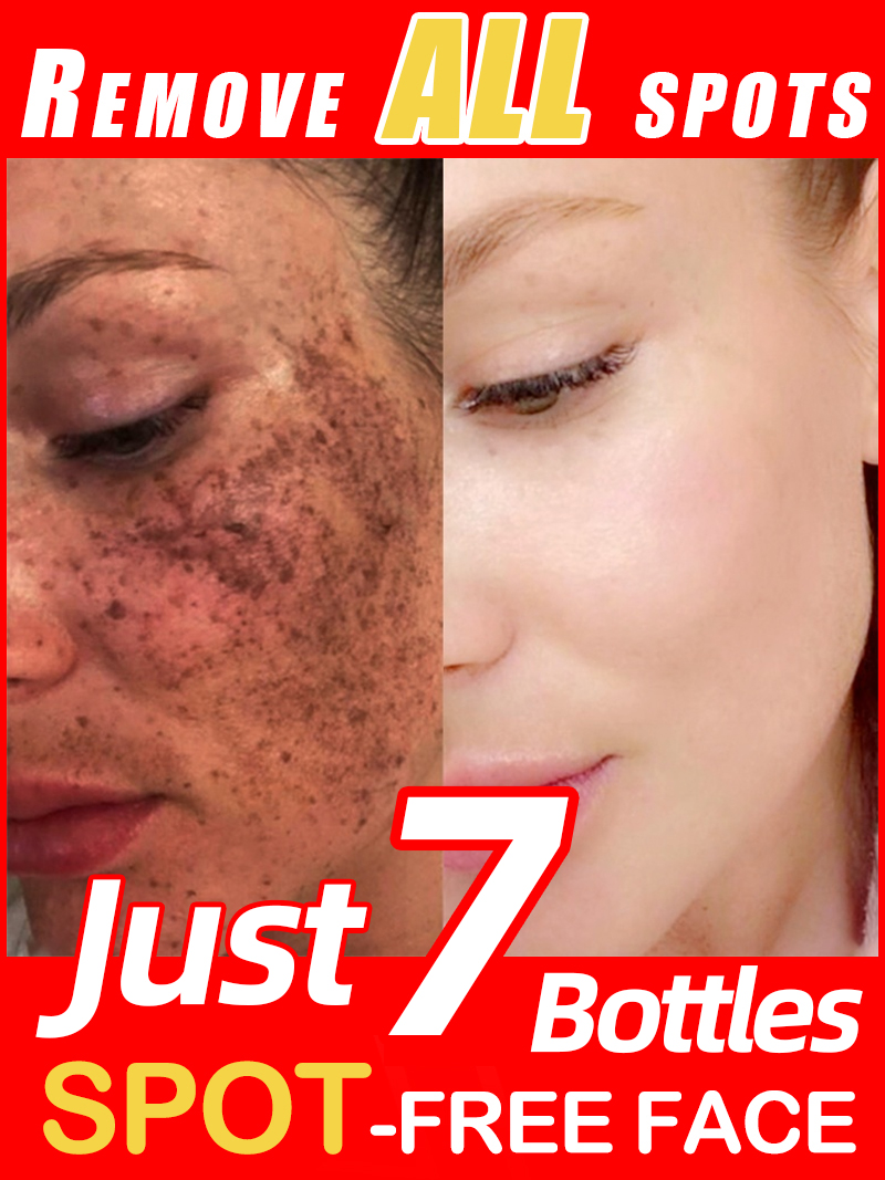 Skincare Luxury Whitening - Lighten Freckles Melasma, Facial Dark Spots
