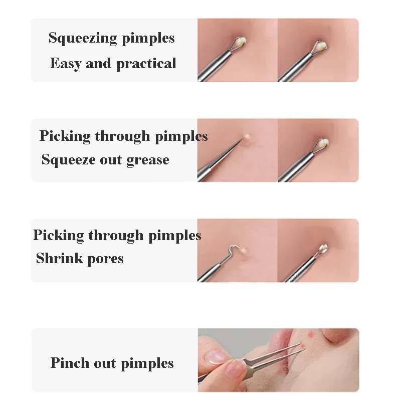 Higt Quality Acne Blackhead Re - Luxury Skincare Acne 评论和价格